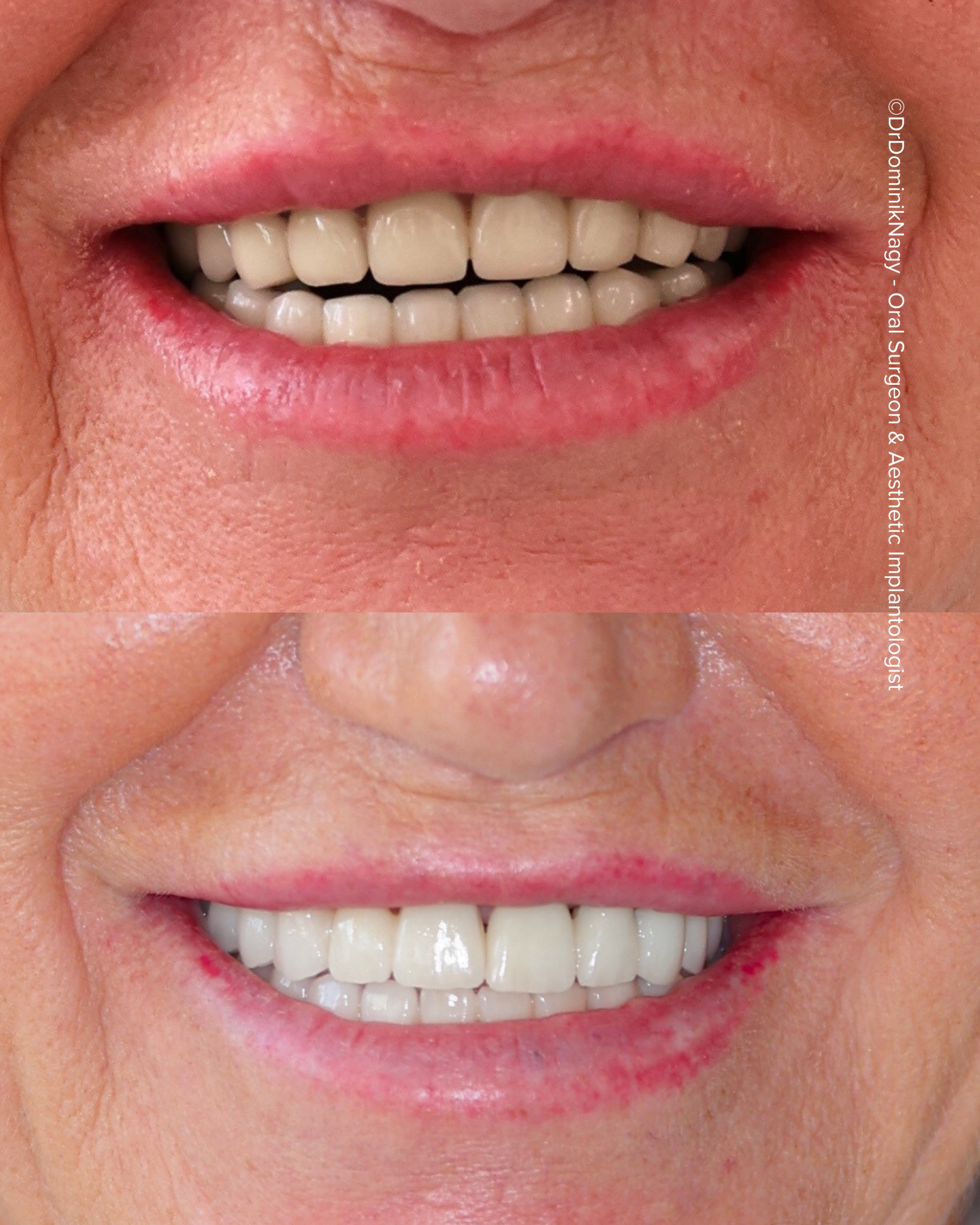 ©Dr. Dominik Nagy Oral Surgeon & Aesthetic Implantologist - Clinical Results
