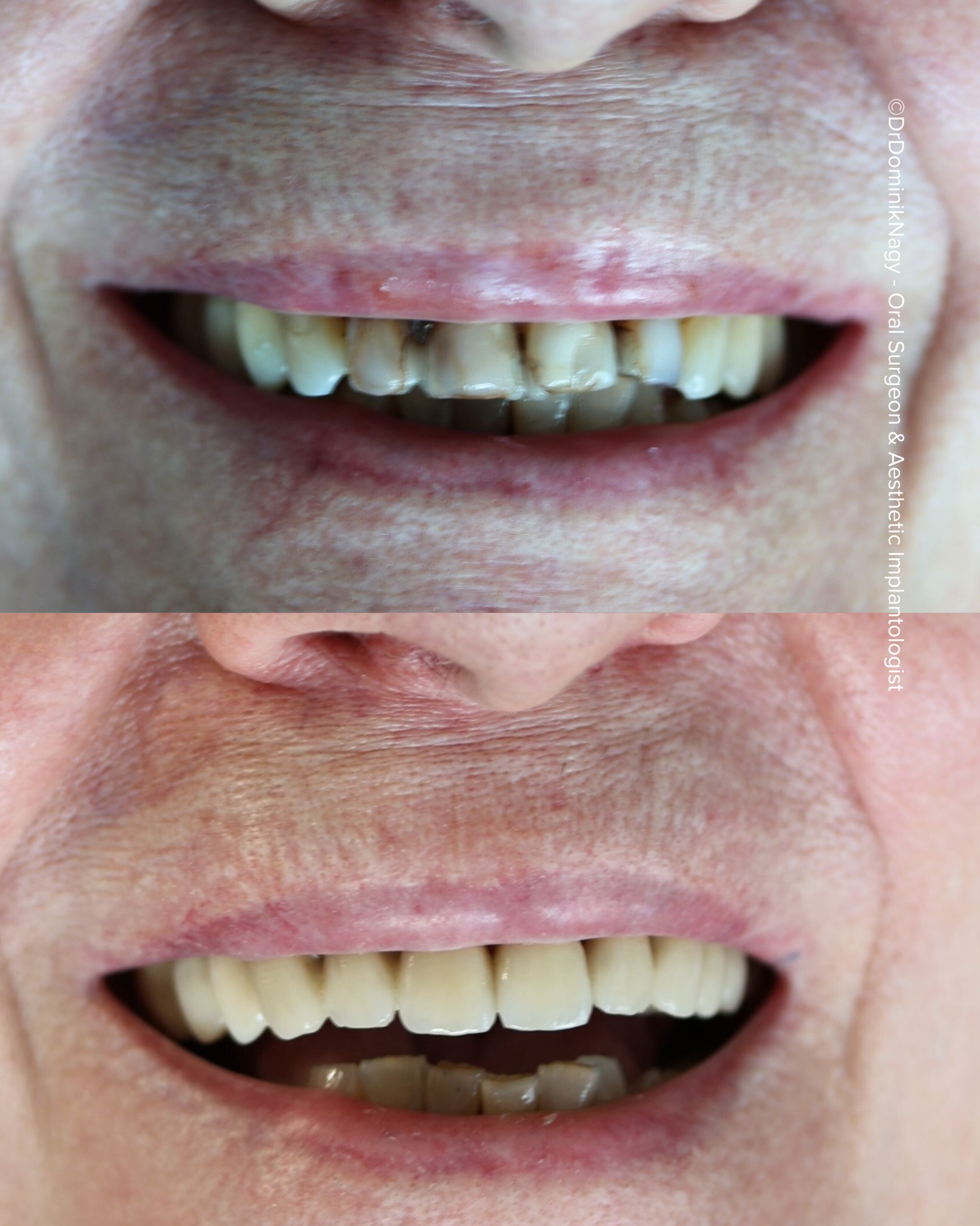 ©Dr. Dominik Nagy Oral Surgeon & Aesthetic Implantologist - Clinical Results