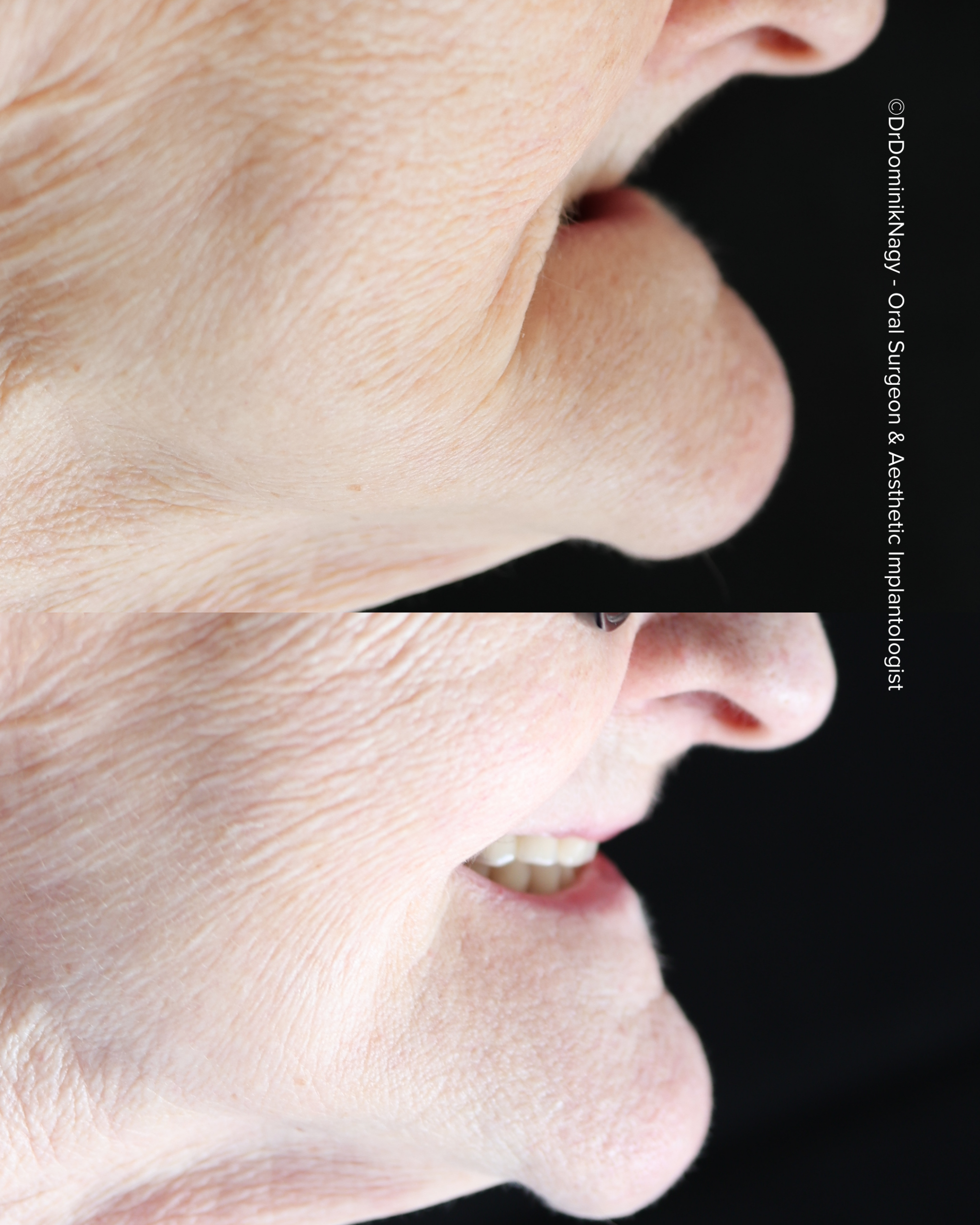 ©Dr. Dominik Nagy Oral Surgeon & Aesthetic Implantologist - Clinical Results