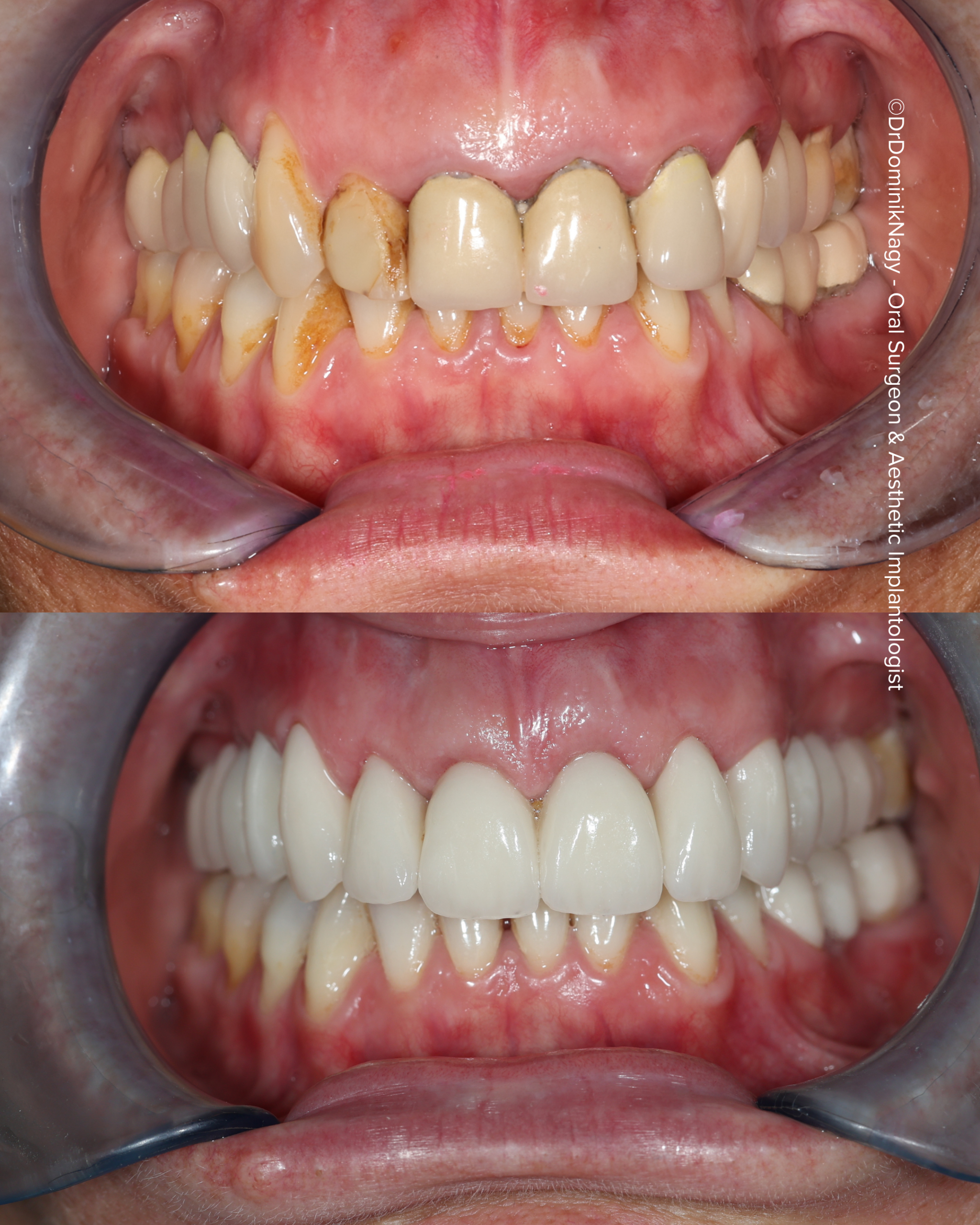 ©Dr. Dominik Nagy Oral Surgeon & Aesthetic Implantologist - Clinical Results ©Dr. Dominik Nagy Oral Surgeon & Aesthetic Implantologist - Clinical Results