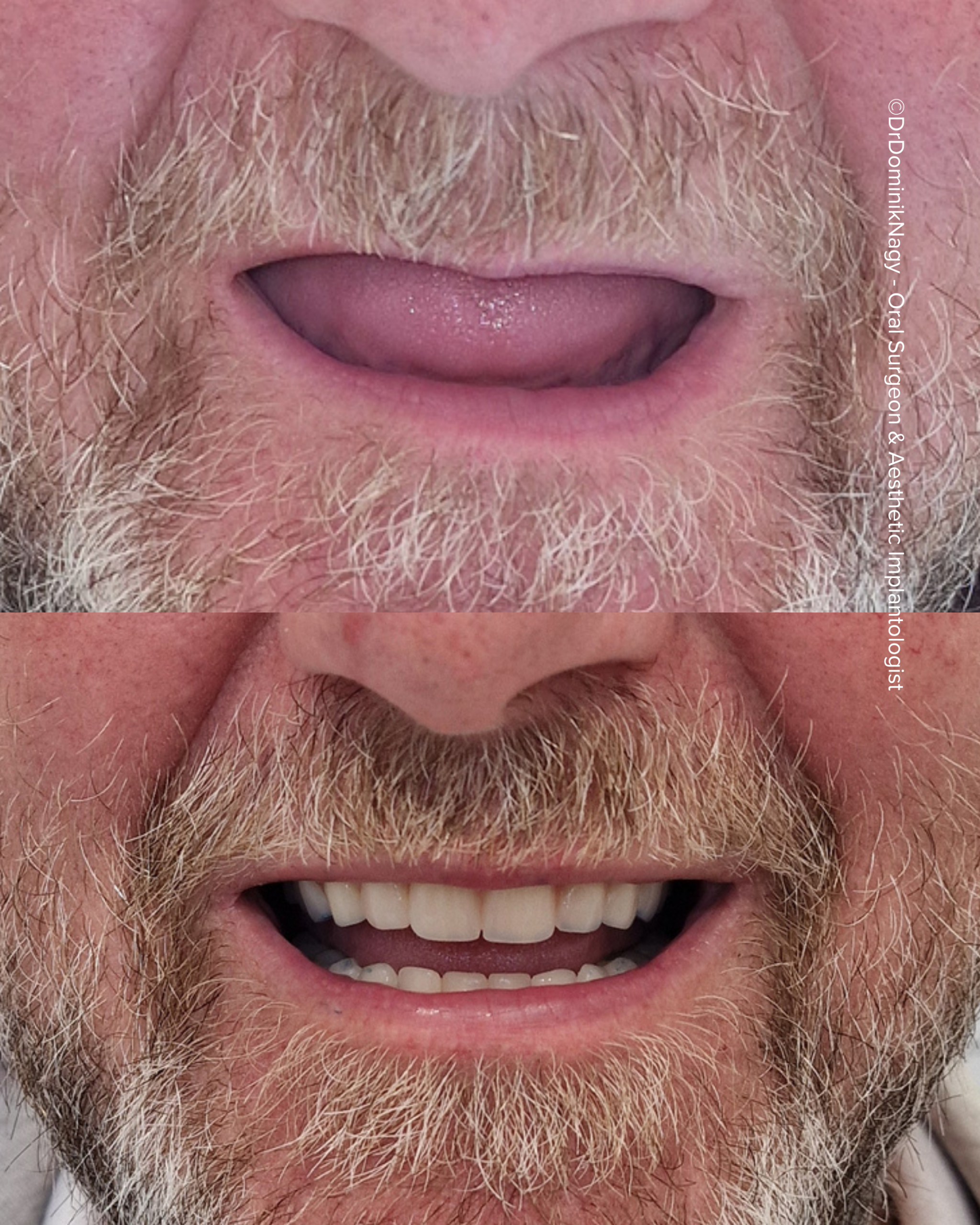 ©Dr. Dominik Nagy Oral Surgeon & Aesthetic Implantologist - Clinical Results ©Dr. Dominik Nagy Oral Surgeon & Aesthetic Implantologist - Clinical Results