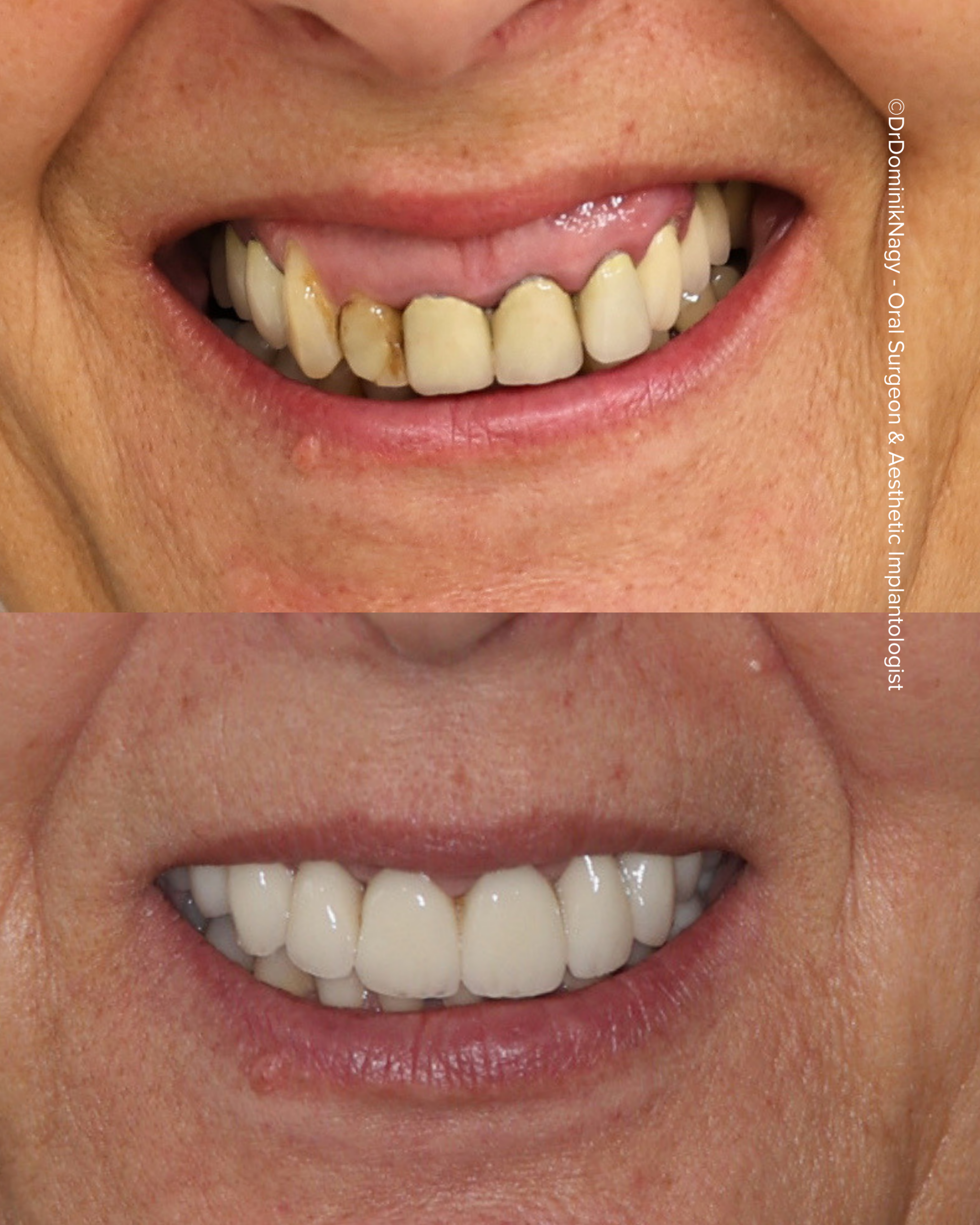 ©Dr. Dominik Nagy Oral Surgeon & Aesthetic Implantologist - Clinical Results ©Dr. Dominik Nagy Oral Surgeon & Aesthetic Implantologist - Clinical Results