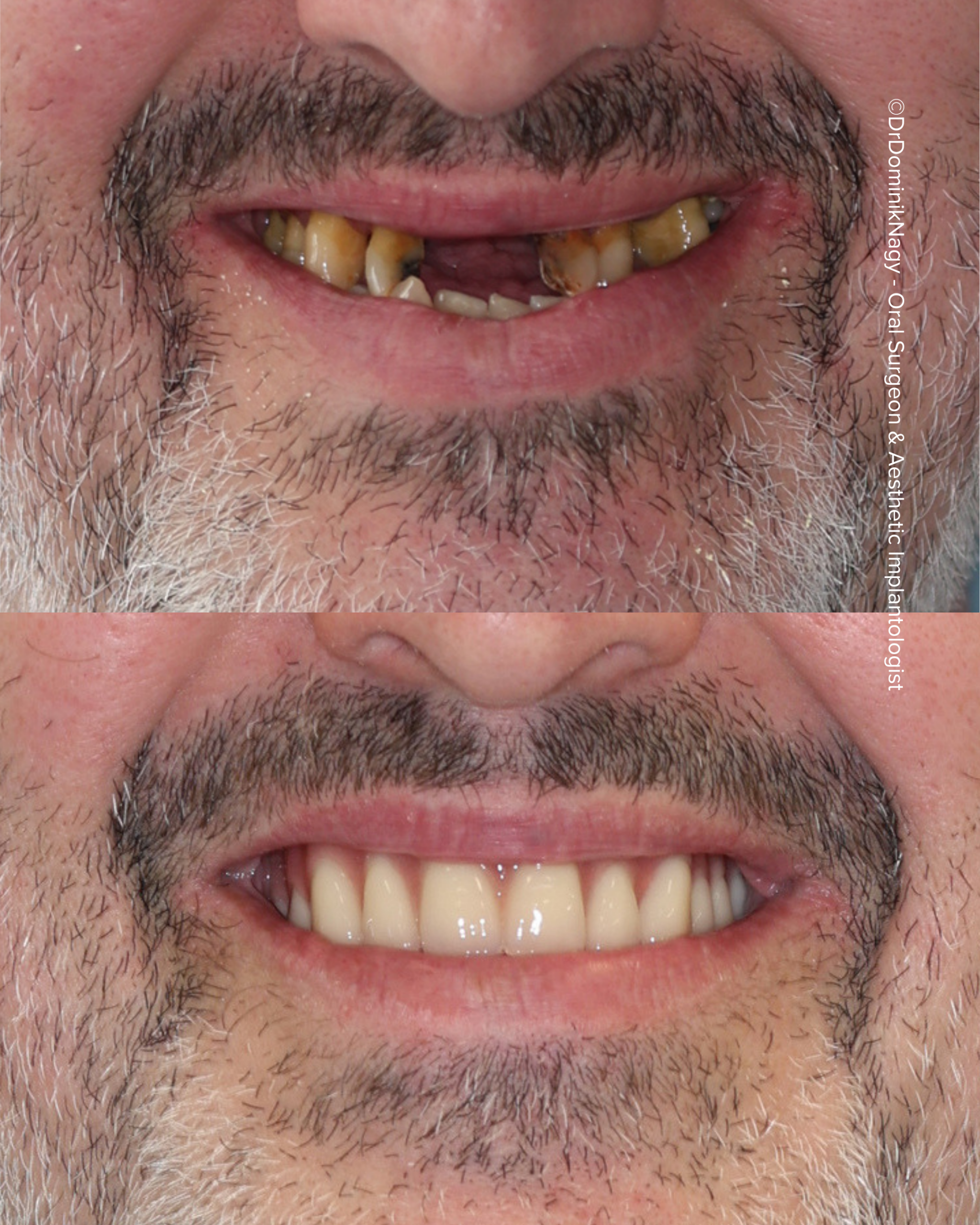©Dr. Dominik Nagy Oral Surgeon & Aesthetic Implantologist - Clinical Results ©Dr. Dominik Nagy Oral Surgeon & Aesthetic Implantologist - Clinical Results